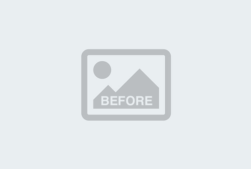 Before Image: Arm Lift- Dr. Tucker - 