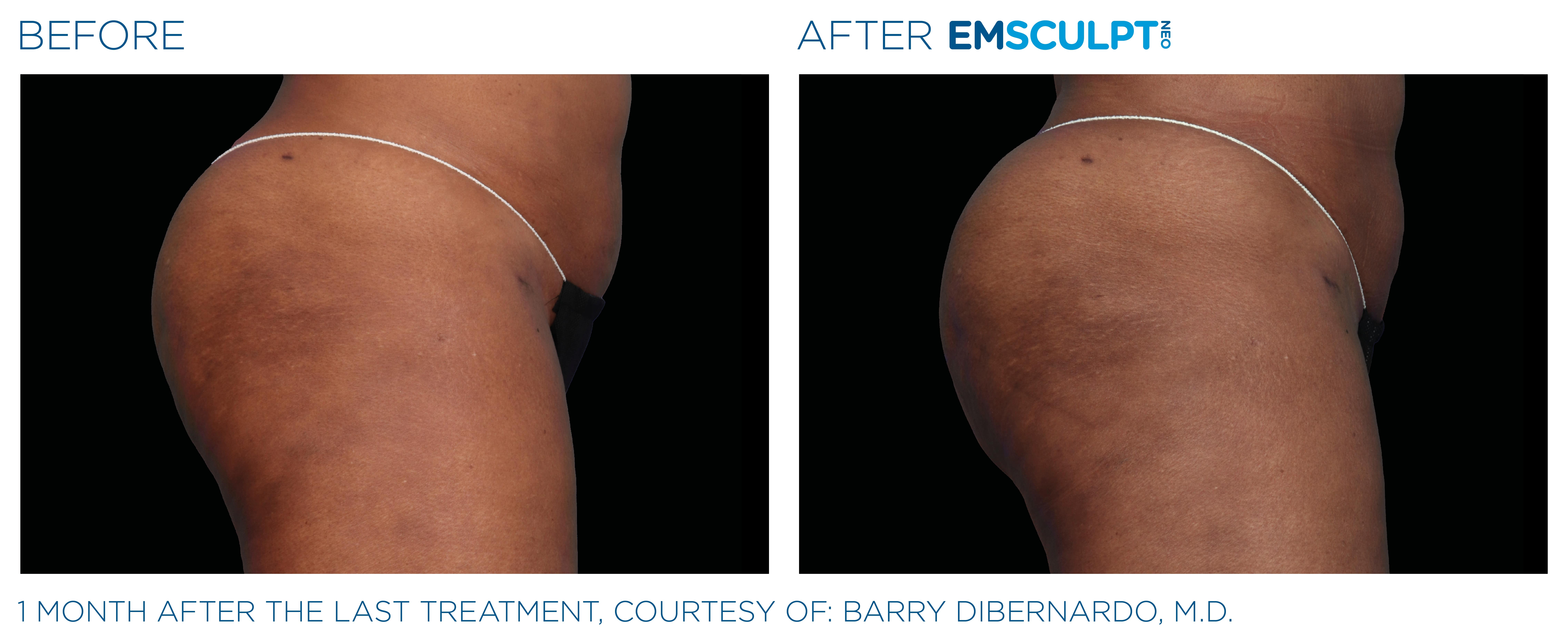 Emsculpt Neo PIC Ba card female buttock 071 ENUS100 1 1
