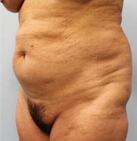 Before Image: Abdominoplasty (Tummy Tuck) – Dr. Howell - left-front-oblique