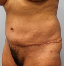 After Image: Abdominoplasty (Tummy Tuck) – Dr. Howell - left-front-oblique