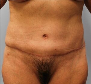 After Image: Abdominoplasty (Tummy Tuck) – Dr. Howell - front