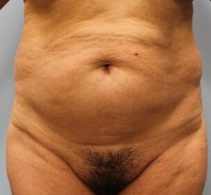 Before Image: Abdominoplasty (Tummy Tuck) – Dr. Howell - front
