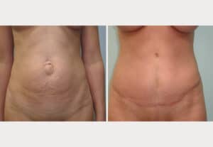 After Image: Abdominoplasty with Hernia Repair – Dr. Tucker