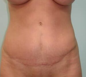 After Image: Abdominoplasty with Hernia Repair – Dr. Tucker - front