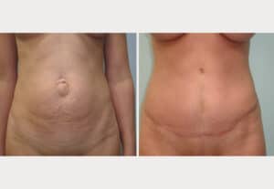 Abdominoplasty with Hernia Repair – Dr. Tucker