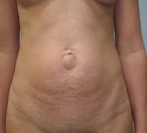 Before Image: Abdominoplasty with Hernia Repair – Dr. Tucker - front