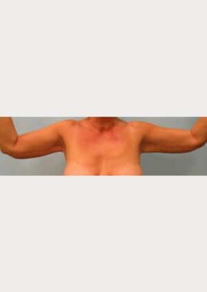 After Image: Brachioplasty – Dr. Howell - front