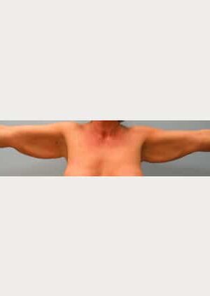 Before Image: Brachioplasty – Dr. Howell - front