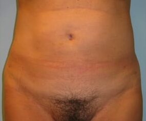 After Image: Liposuction Abdomen, flanks – Dr. Howell - front