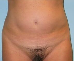 Before Image: Liposuction Abdomen, flanks – Dr. Howell - front