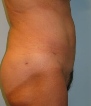 After Image: Liposuction Abdomen, flanks – Dr. Howell - right-side