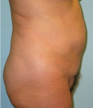 Before Image: Liposuction Abdomen, flanks – Dr. Howell - right-side