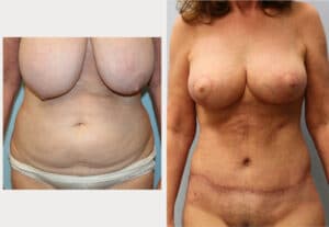 Mommy Makeover – Dr. Howell