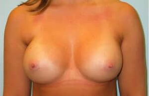 After Image: Breast Augmentation – Dr. Howell - front