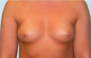 Before Image: Breast Augmentation – Dr. Howell - front