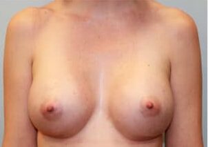 After Image: Breast Augmentation – Dr. Howell - front