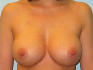 After Image: Breast Augmentation – Dr. Howell - front