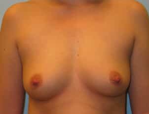 Before Image: Breast Augmentation – Dr. Howell - front