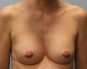 After Image: Breast Augmentation – Dr. Howell - front