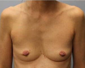 Before Image: Breast Augmentation – Dr. Howell - front