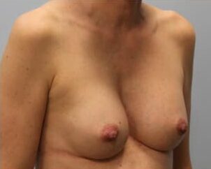 After Image: Breast Augmentation – Dr. Howell - right-front-oblique