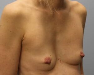 Before Image: Breast Augmentation – Dr. Howell - right-front-oblique