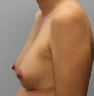 After Image: Breast Augmentation – Dr. Howell - left-side