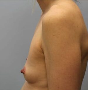 Before Image: Breast Augmentation – Dr. Howell - left-side