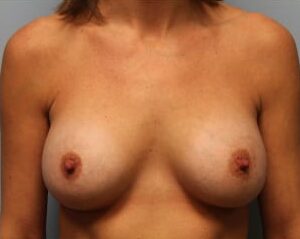 After Image: Breast Augmentation – Dr. Howell - front