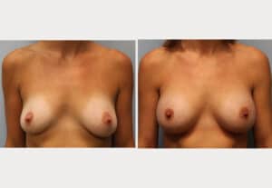 Before Image: Breast Augmentation – Dr. Howell