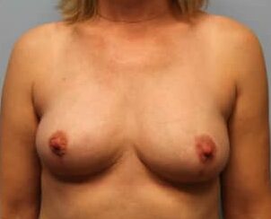 After Image: Breast Augmentation Revision – Dr. Howell - front