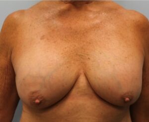 Breast Augmentation Revision – Dr. Howell