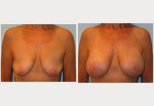 Breast Augmentation with Mastopexy (Lift)