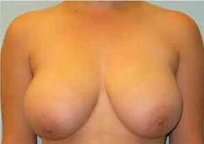 Before Image: Breast Reduction – Dr. Howell - front