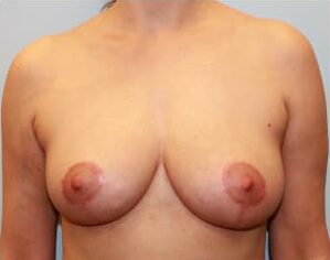 After Image: Breast Reduction – Dr. Howell - front
