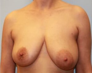 Before Image: Breast Reduction – Dr. Howell - front