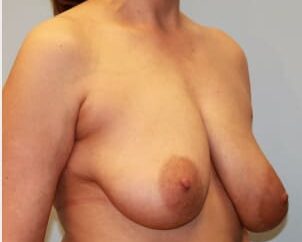 Before Image: Breast Reduction – Dr. Howell - right-front-oblique