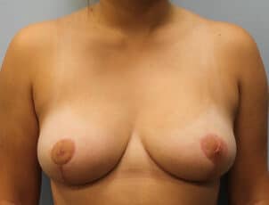 After Image: Breast Reduction – Dr. Howell - front