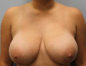 Before Image: Breast Reduction – Dr. Howell - front