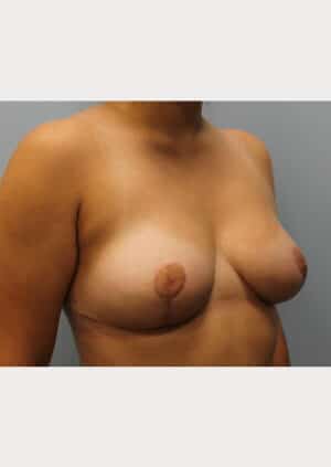 After Image: Breast Reduction – Dr. Howell - right-front-oblique