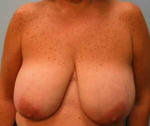 Before Image: Mastopexy (Breast Lift) – Dr. Howell - front