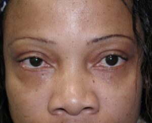 Blepharoplasty – Dr. Tucker