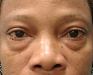 Blepharoplasty – Dr. Tucker
