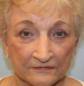 Blepharoplasty – Dr. Tucker