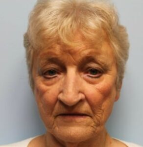Blepharoplasty – Dr. Tucker