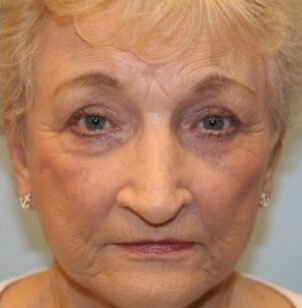 After Image: Facelift, Rhinoplasty, & Blepharoplasty – Dr. Tucker - front