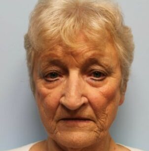 Before Image: Facelift, Rhinoplasty, & Blepharoplasty – Dr. Tucker - front