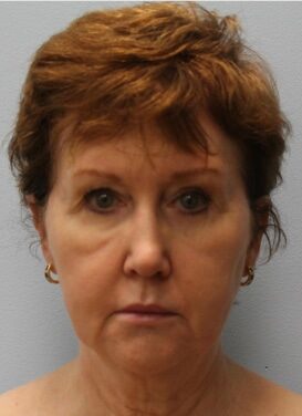 Before Image: Facelift – Dr. Howell - front