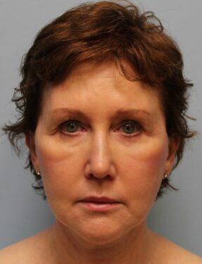 After Image: Facelift – Dr. Howell - front