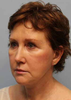 After Image: Facelift – Dr. Howell - left-front-oblique